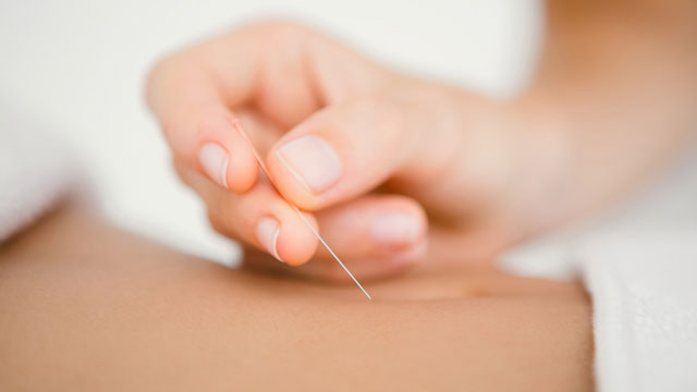 Acupuncture